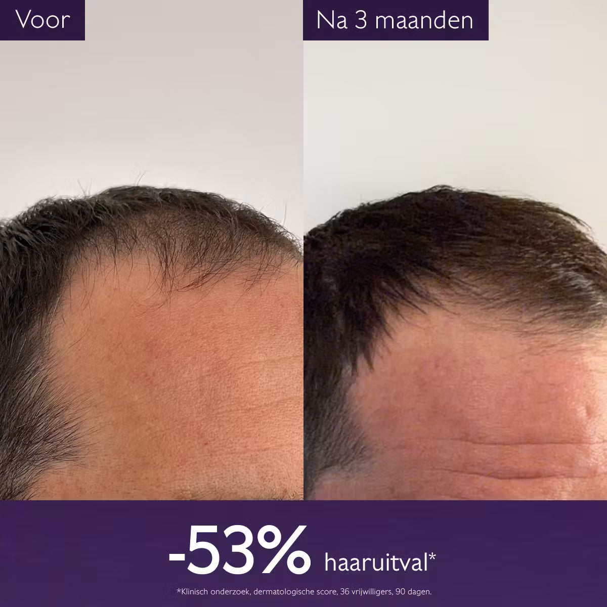 Anti-haaruitval Serum
